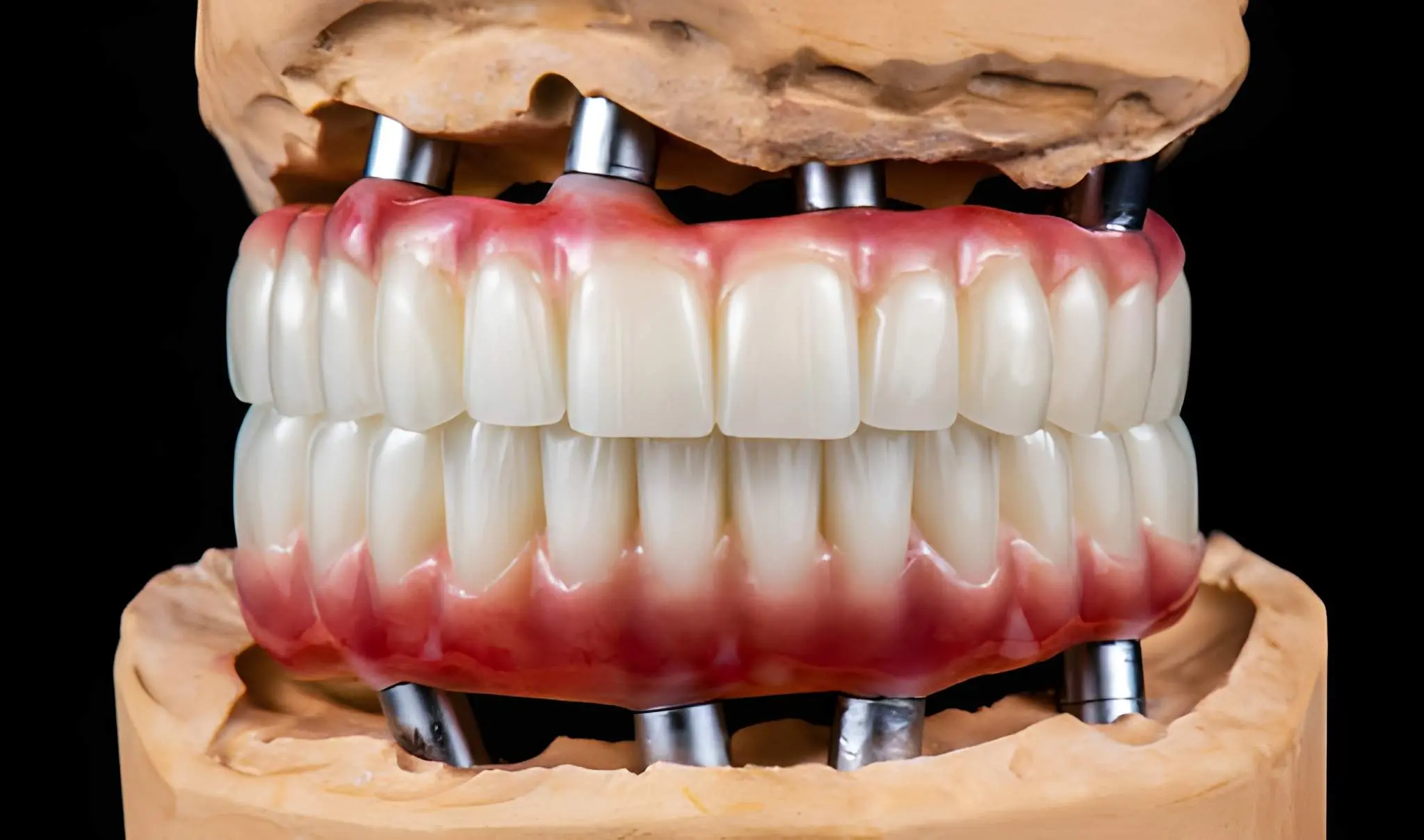 Smart Smile Decisions All on 4 vs Traditional Implants