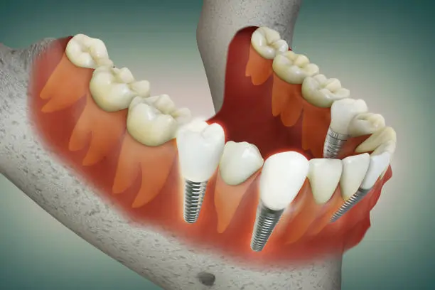 The Role of Jawbone Health in Dental Implant Success